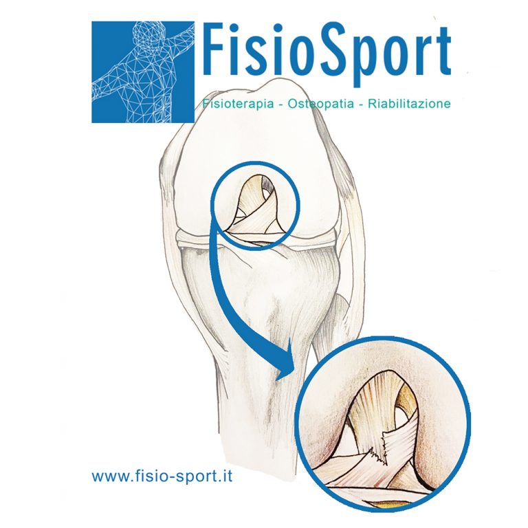 Legamento Crociato Anteriore (LCA) | FisioSport