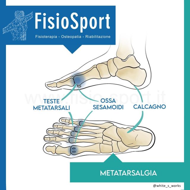Metatarsalgia FisioSport